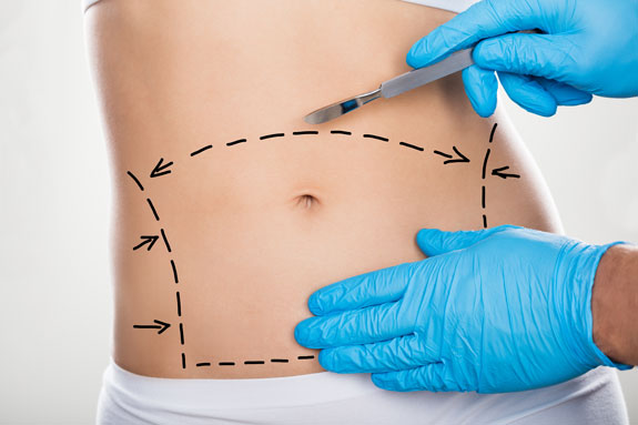 Abdominoplastik Starnberg